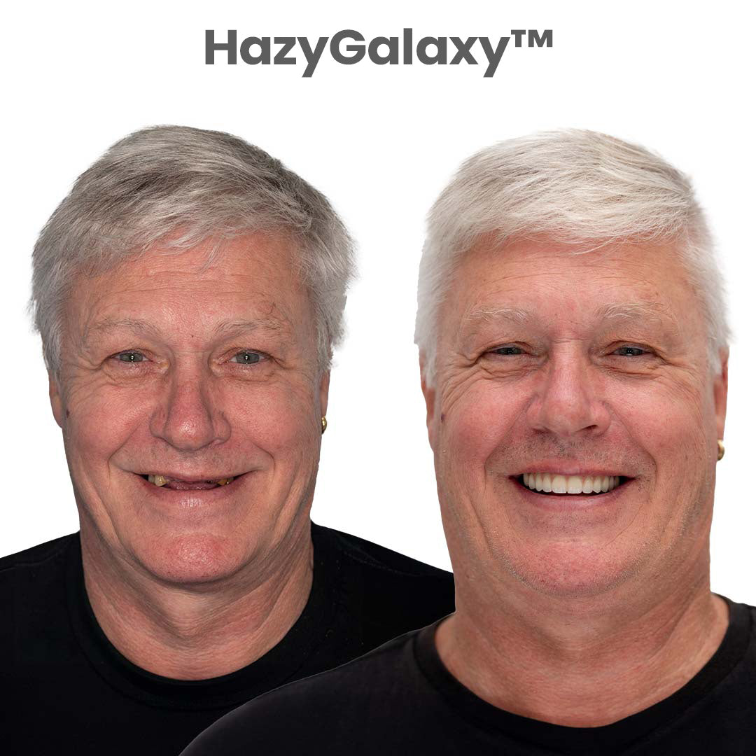 ⏰ HazyGalaxy™ Custom-Fit Dentures ENDS TODAY 70% OFF | Smile with Confidence