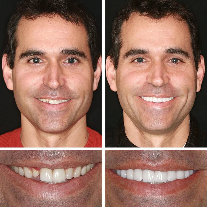 DarkFairy™ Medical Full Denture with Strong Suctiond Custom-Fit Full Functional Dentures🦷