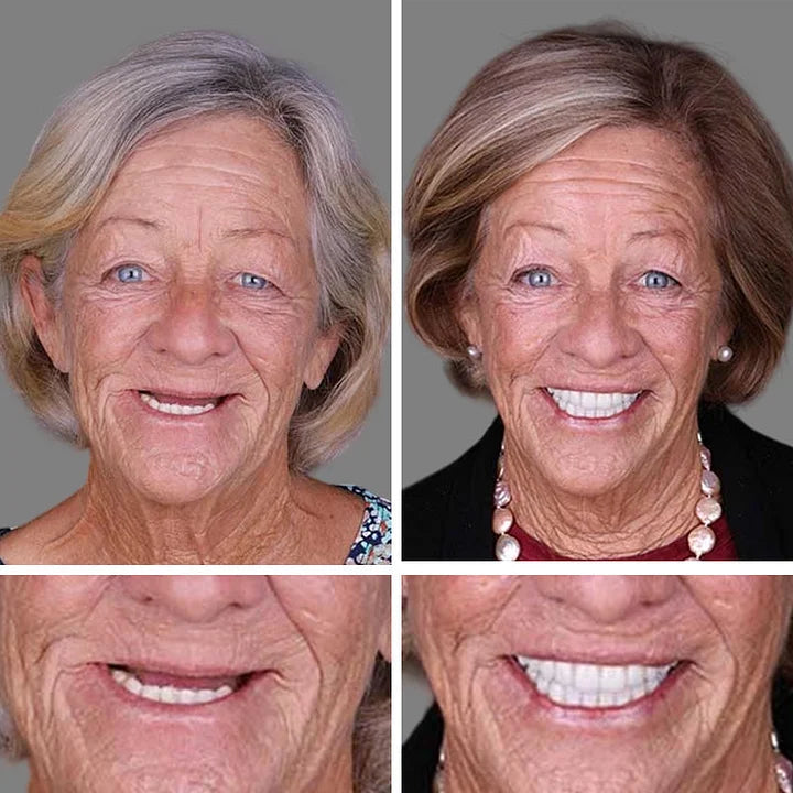 DarkFairy™ Medical Full Denture with Strong Suctiond Custom-Fit Full Functional Dentures🦷