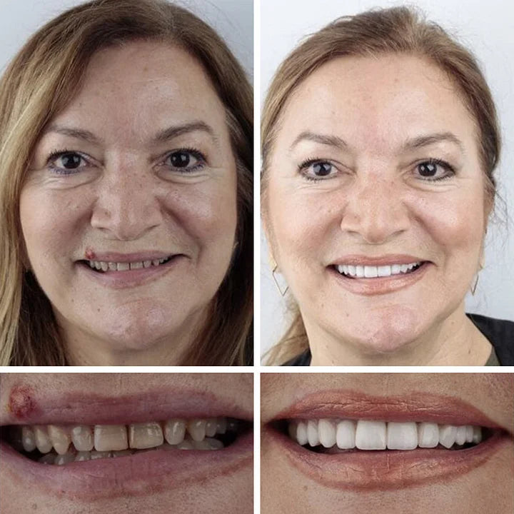 DarkFairy™ Medical Full Denture with Strong Suctiond Custom-Fit Full Functional Dentures🦷