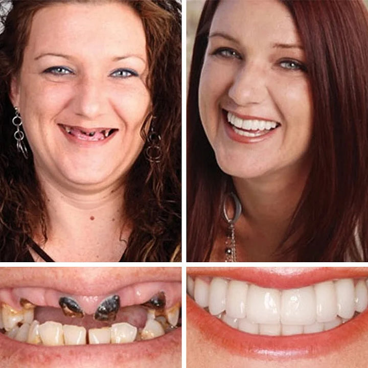 DarkFairy™ Medical Full Denture with Strong Suctiond Custom-Fit Full Functional Dentures🦷