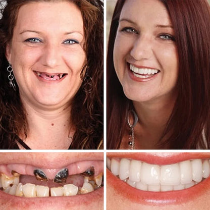DarkFairy™ Medical Full Denture with Strong Suctiond Custom-Fit Full Functional Dentures🦷